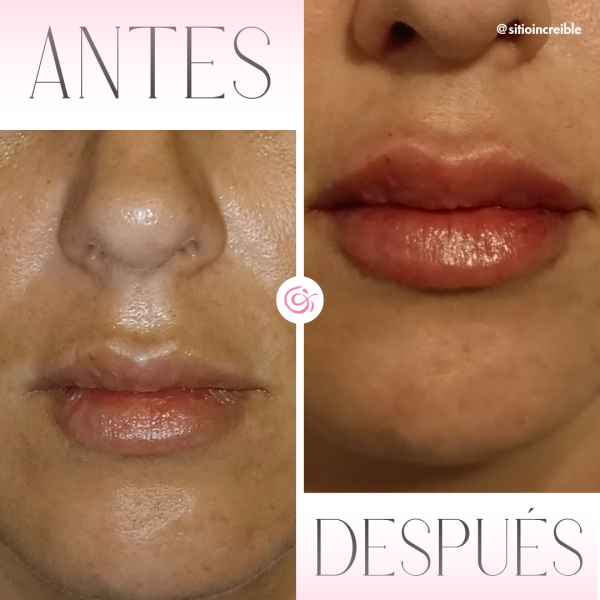 Relleno y/o Perfilado de Labios - Imagen 3
