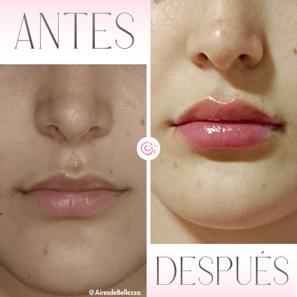 Relleno y/o Perfilado de Labios - Imagen 2