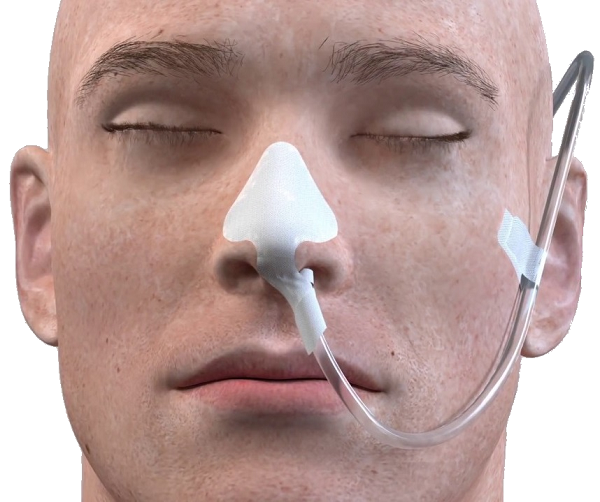 INSTALACIÓN DE SONDAS